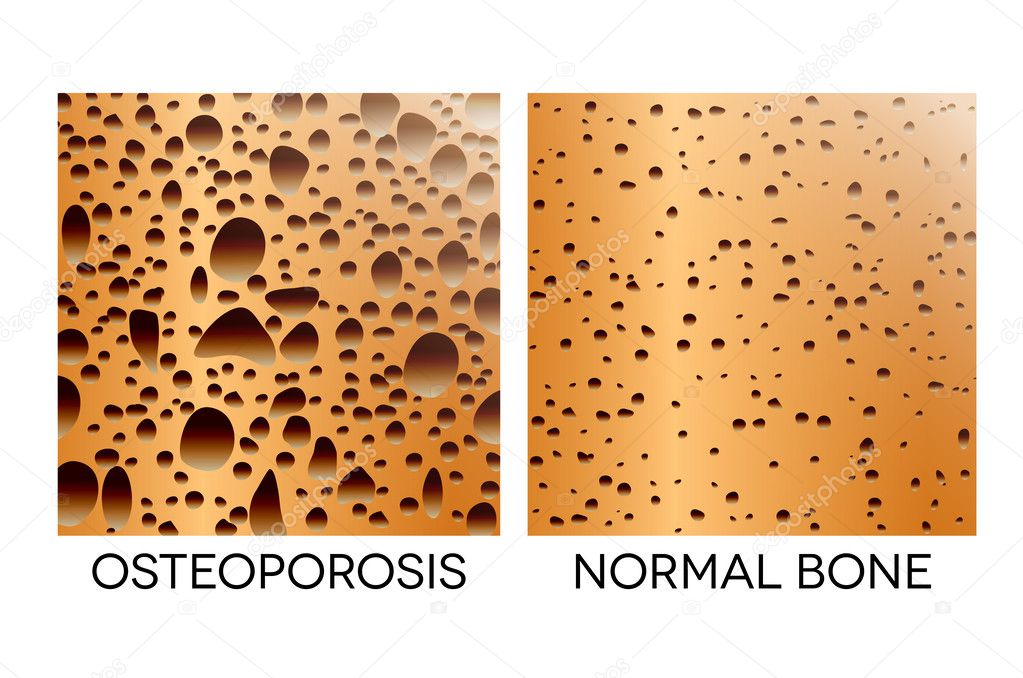 Osteoporosis, unhealthy bone