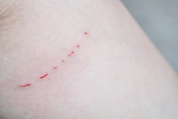 Cicatriz Sangrante Primer Plano Piel Los Caucásicos Debido Arañazos Gato — Foto de Stock