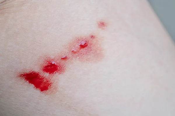 Cicatriz Sangrante Piel Los Caucásicos Debido Arañazos Gato Imagen De Stock