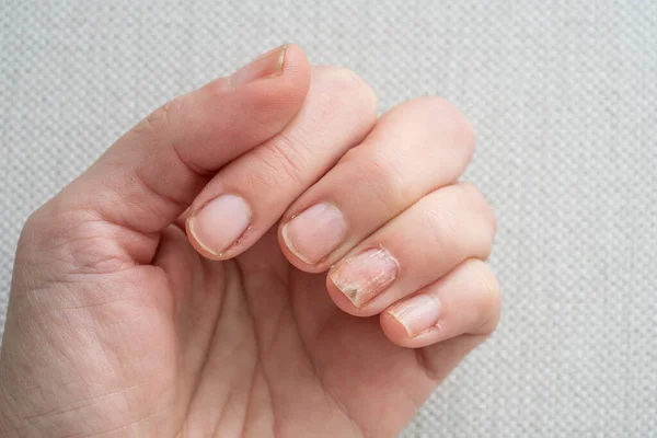 Fungus Closeup Nail Fungus Infection Hand Finger White Caucasian Woman Stock Picture