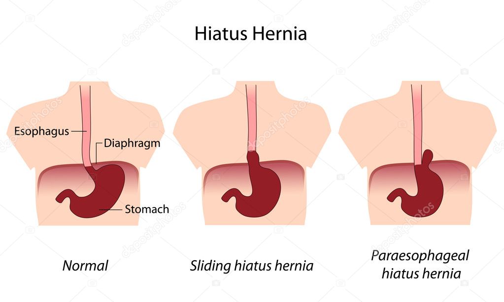 hiatus hernia | 图库矢量图片 08 alila #12647202