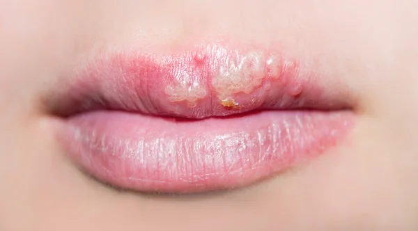 Manifestation of herpes — Stock Photo, Image