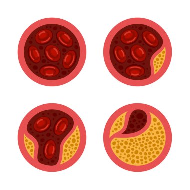 Ateroskleroz. Kan damarlarında kolesterol ayarlandı. Vektör illüstrasyonu