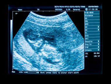Hamilelik ultrason görüntü cihazları monitörden
