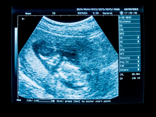 Hamilelik ultrason görüntü cihazları monitörden
