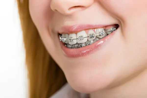 Beautiful young woman with brackets on teeth — Stock Photo, Image