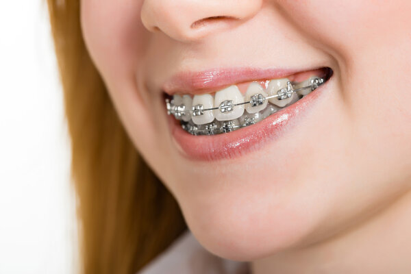 Beautiful young woman with brackets on teeth