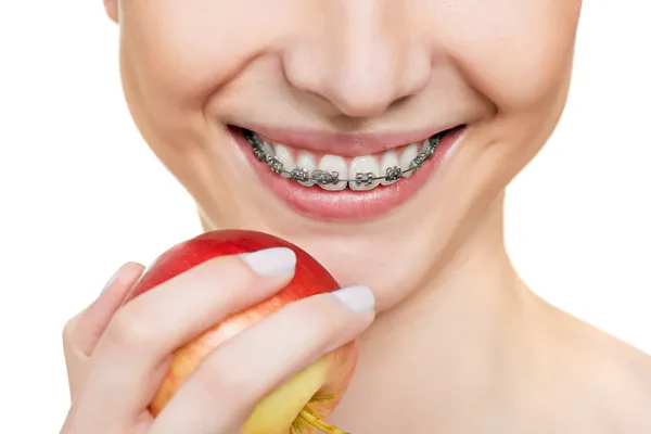 Brackets on teeth — Stock Photo, Image