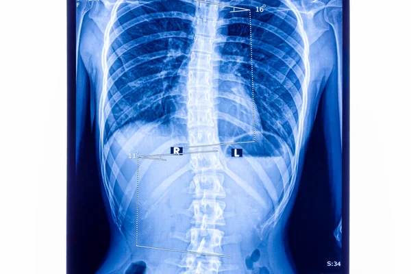 X ray showing scoliosis of the lumbar spine. Scoliosis is an abnormal lateral curvature of the spine.