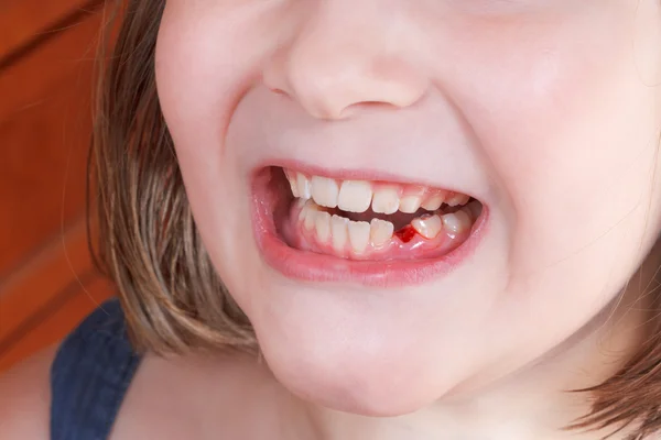 Dente de bebê caído na boca da menina — Fotografia de Stock