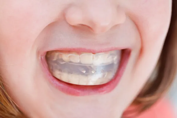 Correction of occlusion by orthodontic trainer — Stock Photo, Image