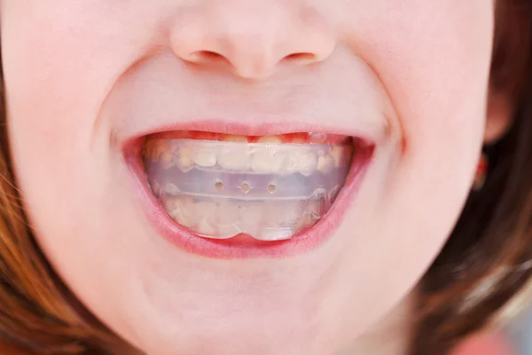 Correction of occlusion by orthodontic trainer — Stock Photo, Image