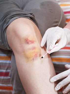 iodine painting of bruise on knee clipart