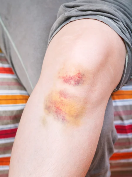Lesão no joelho - hematoma na perna — Fotografia de Stock