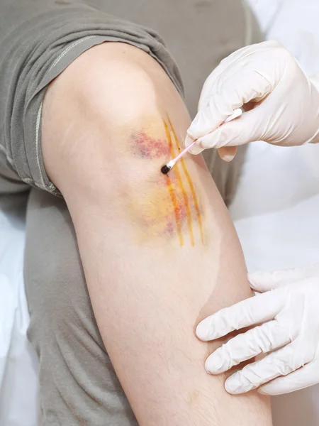 Iodine grid painting of knee injury — Stock Photo, Image