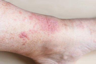 Alerjik temas dermatiti örneği. Erkek bacağında egzama.