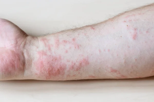 Sample Allergic Contact Dermatitis Itchy Rash Side Forearm Close — Stock Photo, Image