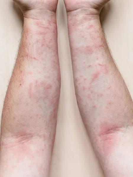 Vzorek Alergické Kontaktní Dermatitidy Mužské Paže Svědivou Zarudlou Vyrážkou — Stock fotografie