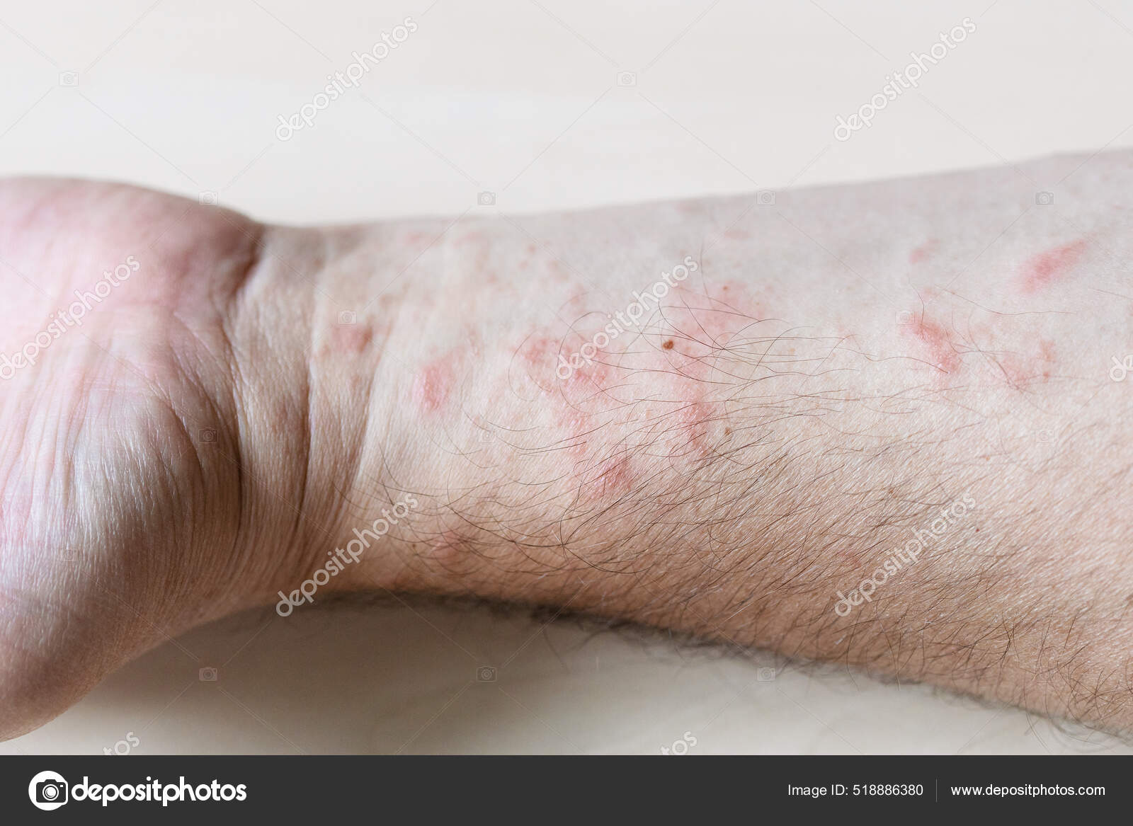 Échantillon Dermatite Contact Allergique Éruption Cutanée Sur Face ...