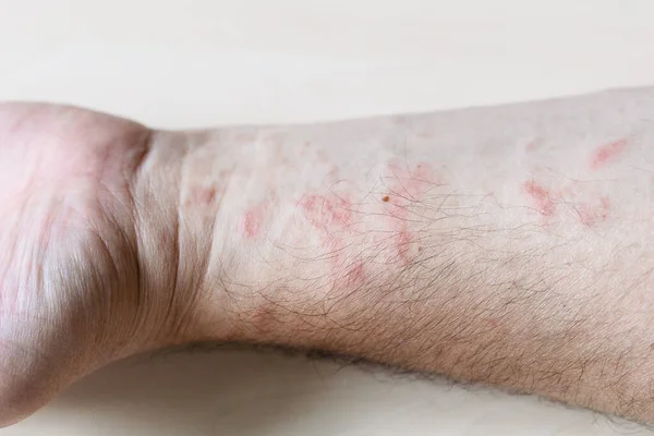 Vzorek Alergické Kontaktní Dermatitidy Vyrážka Vnitřní Straně Předloktí Zblízka — Stock fotografie