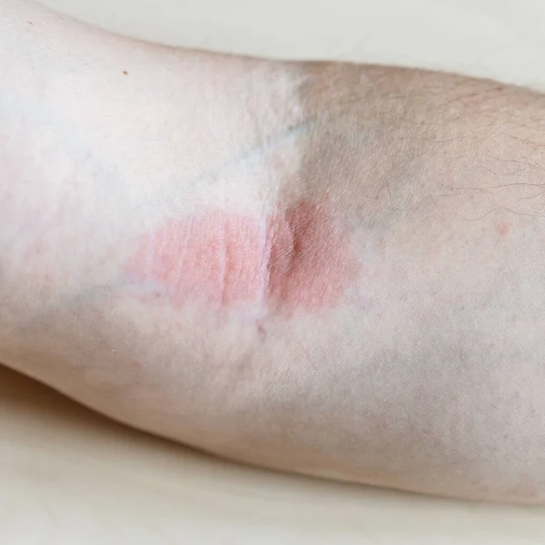 Vzorek Alergické Kontaktní Dermatitidy Zčervenání Vnitřní Ohyb Lokte Zblízka — Stock fotografie