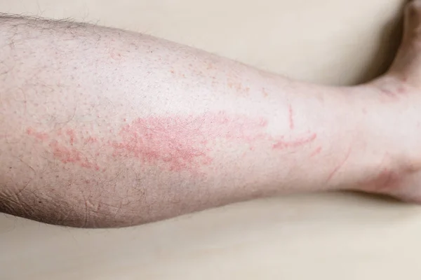 Vzorek Alergické Kontaktní Dermatitidy Boční Strana Holeně Samčího Pohlaví Svědivou — Stock fotografie