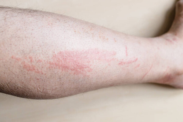 sample of Allergic contact dermatitis - side of male shin with itchy red rash