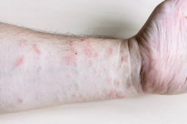 Amostra Dermatite Alérgica Contato Erupção Cutânea Rosa Lado Interno Antebraço — Fotografia de Stock