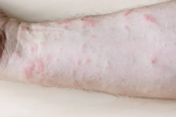 Échantillon Dermatite Contact Allergique Papules Sur Face Interne Avant Bras — Photo