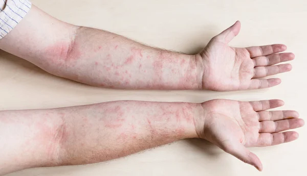 Échantillon Dermatite Contact Allergique Bras Mâles Infectés Par Une Maladie — Photo