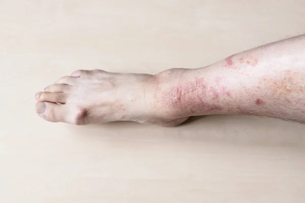 Amostra Dermatite Alérgica Contato Canela Masculina Com Prurido Erupção Cutânea — Fotografia de Stock