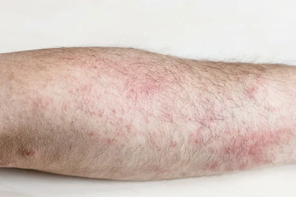 Vzorek Alergické Kontaktní Dermatitidy Vyrážka Předloktí Zblízka — Stock fotografie