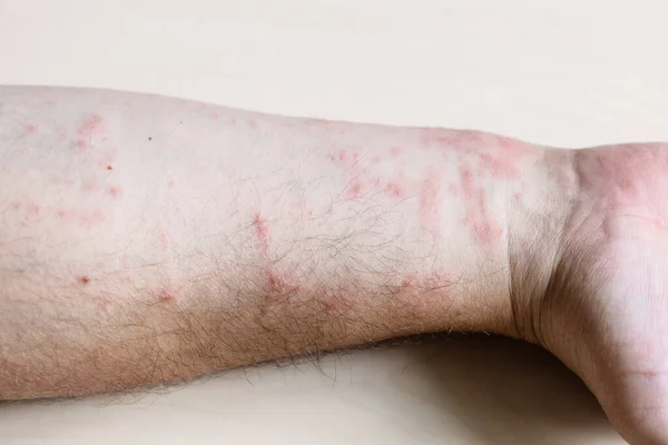 Amostra Dermatite Alérgica Contato Inflamação Pele Lado Interno Antebraço Perto — Fotografia de Stock
