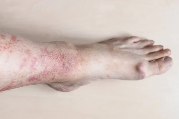 Échantillon Dermatite Contact Allergique Tibia Mâle Avec Rougeur Éruption Cutanée — Photo