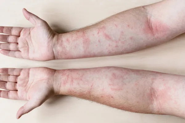 Vzorek Alergické Kontaktní Dermatitidy Mužské Paže Zánětem Kůže — Stock fotografie