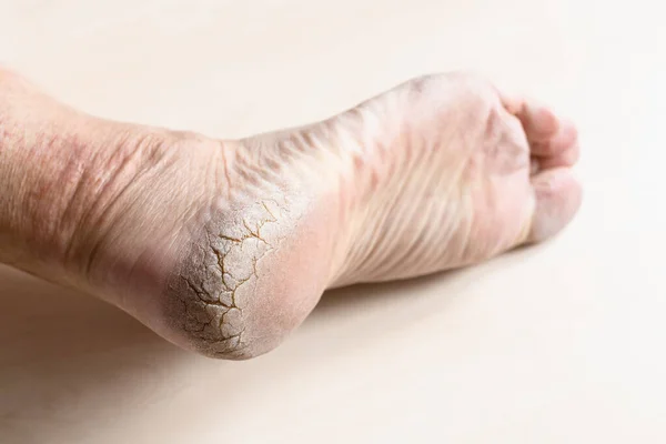 男性の足のかかとの上で死んだ乾燥した割れた皮膚を閉じる — ストック写真