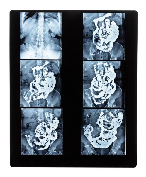 Film Set Ray Radiogram Barium Studies Small Bowel Isolated White — Stock Photo, Image