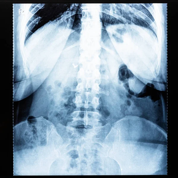 Ray Radiogram Human Body Barium Study Small Bowel — Stock Photo, Image