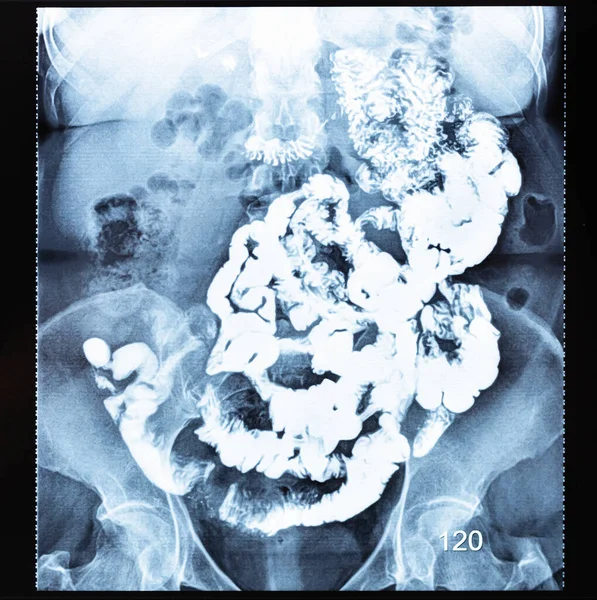 Ray Radiogram Barium Study Small Bowel 120 Minutes Two Hours — Stock Photo, Image