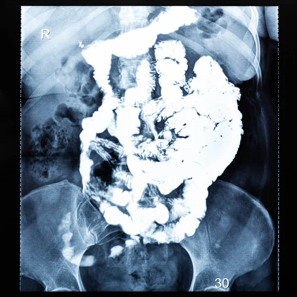 Ray Radiogram Barium Study Small Bowel Thirty Minutes Start Passage — Stock Photo, Image