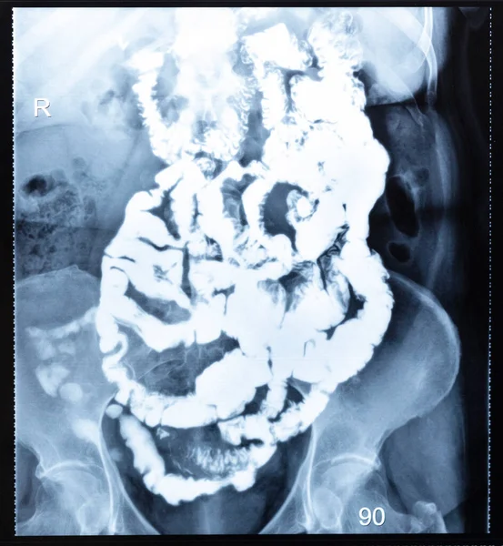 Ray Radiogram Barium Study Small Bowel Ninety Minutes Start Passage — Stock Photo, Image