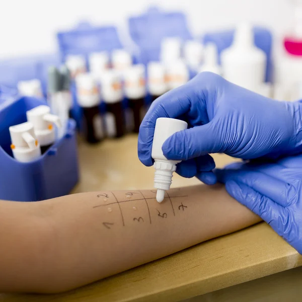 Allergy - skin prick tests — Stock Photo, Image