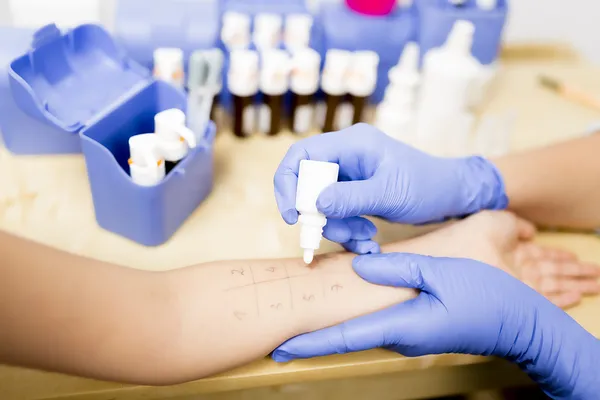 Аллергия - тест на укол кожи — стоковое фото