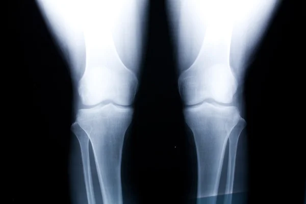 Knie x-ray afbeelding — Stockfoto