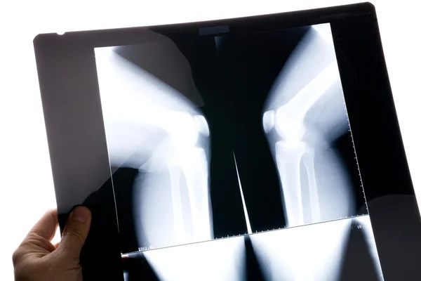 Immagine a raggi X del ginocchio — Foto Stock