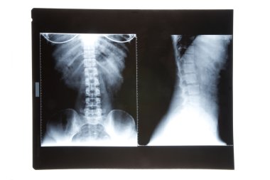 x-ray görüntü