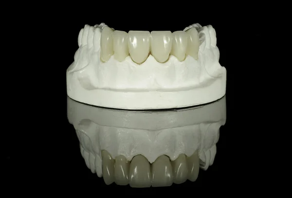 Dental Bridge on a model — Stock Photo, Image