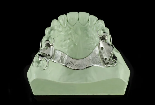 Dentystycznych ram metalowych na modelu — Zdjęcie stockowe