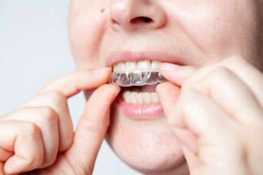 A woman carefully puts a plastic retention cap on her upper teeth with her fingers. Woman face and mouth close-up on a gray backgroun