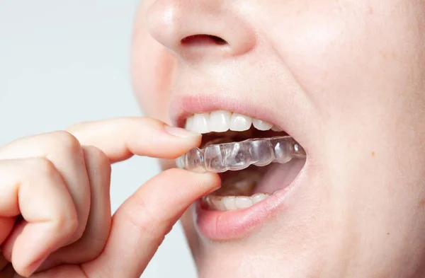 Woman Carefully Puts Plastic Retention Cap Her Upper Teeth Her Photo De Stock